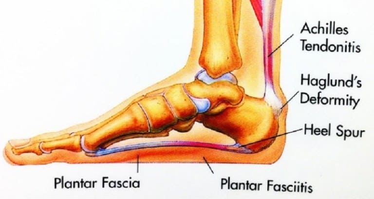 Plantar Fasciitis Sucks!